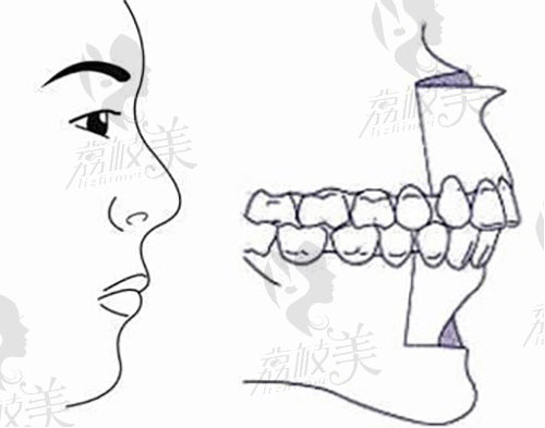 为什么医生说门牙外凸不建议再矫正了，大多数都指骨性龅牙的患者