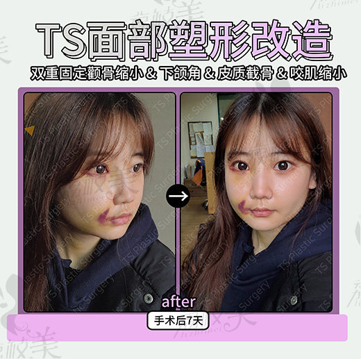 术后7天
