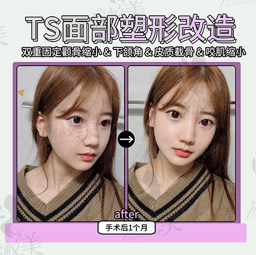 术后1个月