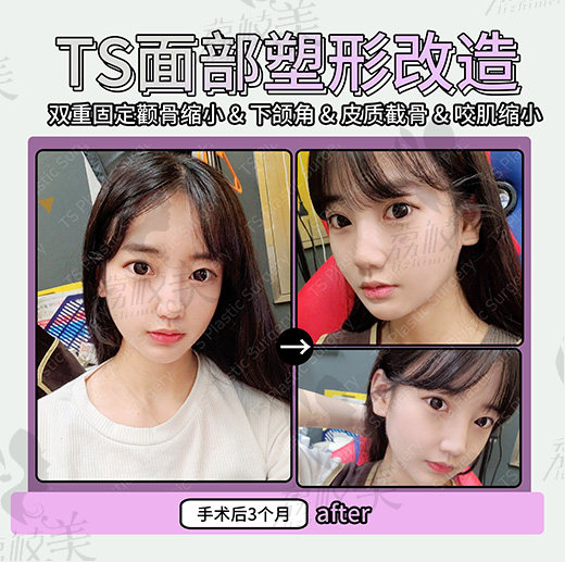 术后3个月