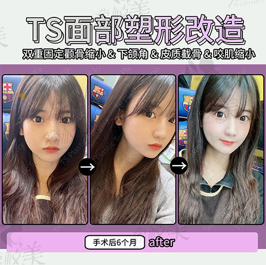 术后6个月