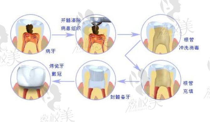 根管治疗示意图