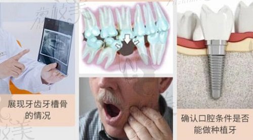 上海瑞伢美口腔瑞亭门诊种植牙术前检查