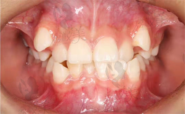矫正前