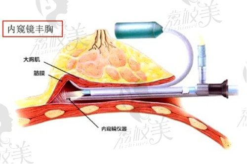 合肥華美整形趙輯院長(zhǎng)做內(nèi)窺鏡隆胸