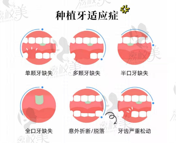 种植牙适应症