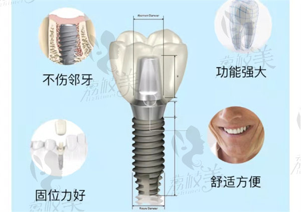 种植牙优势