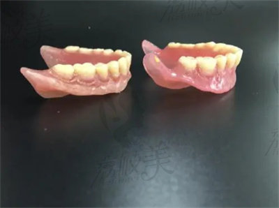 何希俊医生做的全口义齿活动假牙修复的优势.jpg
