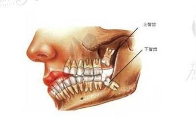 阻生齿及复杂牙拔除.jpg