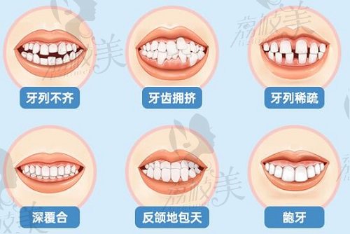 国产金属自锁牙齿矫正适应症