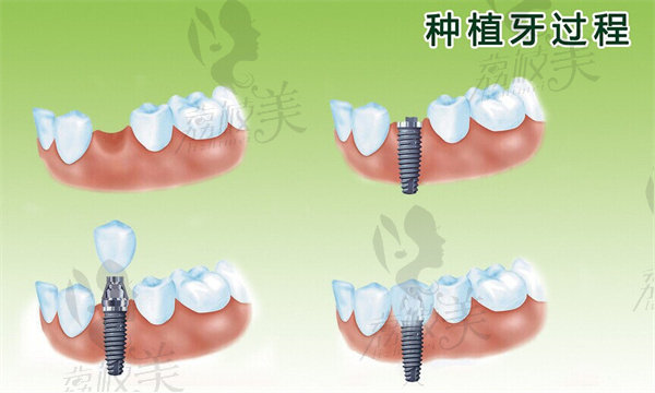 種植牙過程