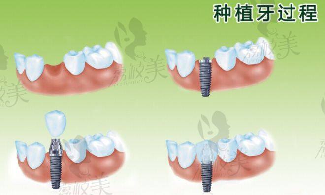 种植牙过程