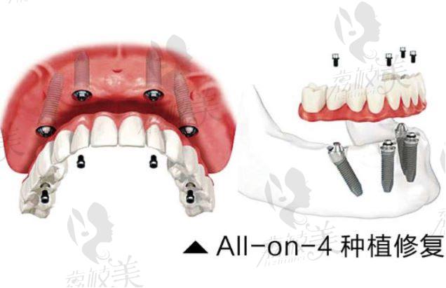 深圳世紀(jì)河山口腔半口種植