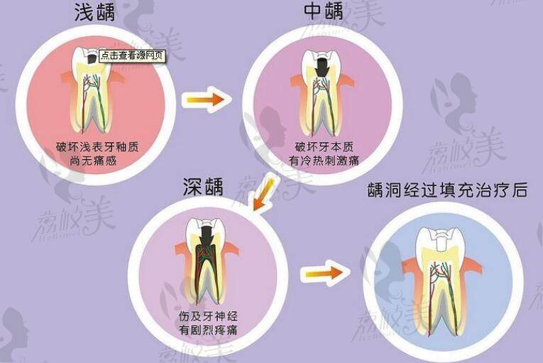 牙齿龋齿的程度图