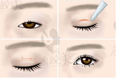双眼皮手术2.jpg