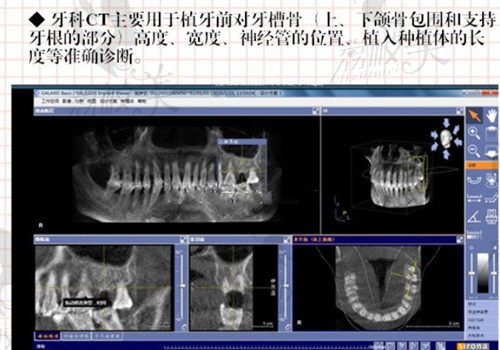 北京京立口腔陈丹做种植牙术前CT