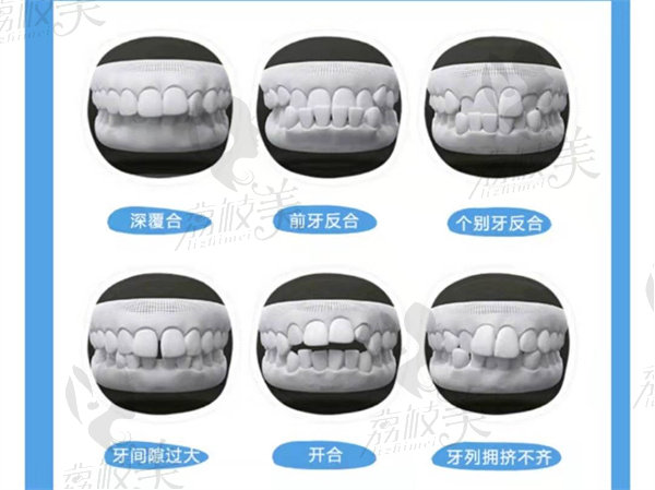 牙齿畸形