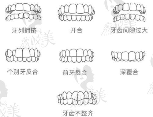 牙齿矫正适应症范围