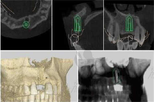上海尤旦口腔导板种植方案