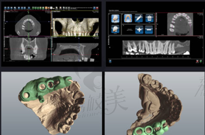 隐乐齿科种植牙模拟种植过程