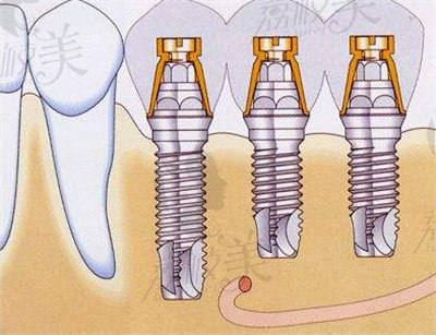 半口牙颌种植的技术优势.jpg