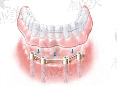半口牙颌种植的技术优势2.jpg