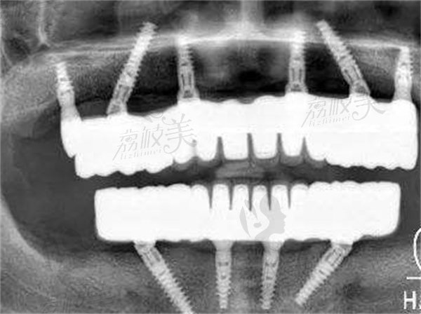 全口种植牙