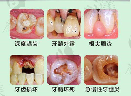 需要根管治療的六大情況