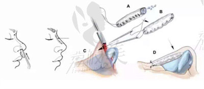 隆鼻技術(shù).jpg