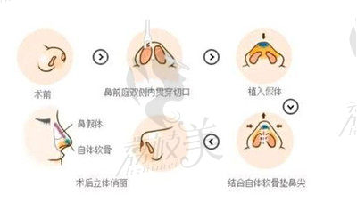 韓士生科肋軟骨隆鼻的優(yōu)點(diǎn).jpg