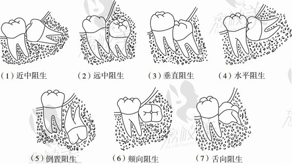 阻生智齿类型