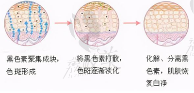 美亚医疗美容祛斑