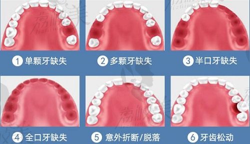 牙齿缺失的情况