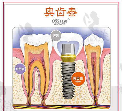 韩国奥齿泰种植牙质量怎么样