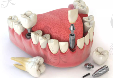 广安爱牙仕口腔种植牙