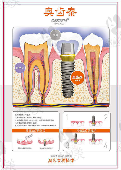 韩国奥齿泰种植牙特点优势