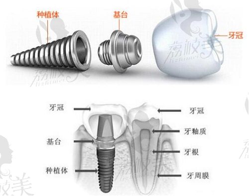 种植牙的组成