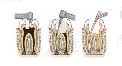 根管治疗