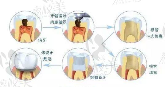 根管治疗流程