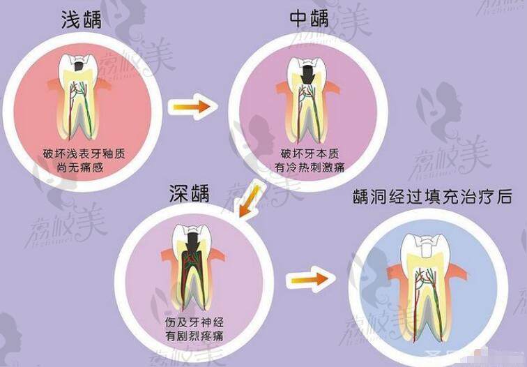 兒童齲齒的治療