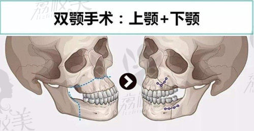 双颚手术原理