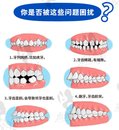 需要牙齿矫正的类型