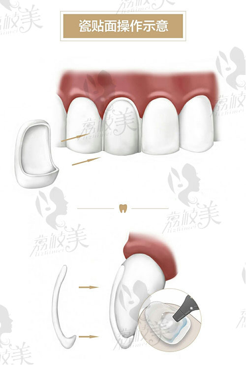 牙齿贴面的过程是怎样？牙齿贴面操作