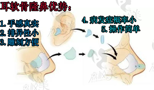 耳软骨隆鼻优势