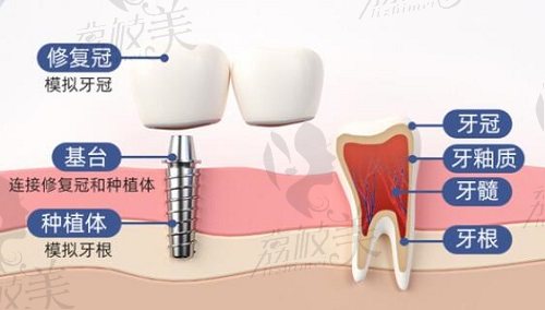 种植牙的组成