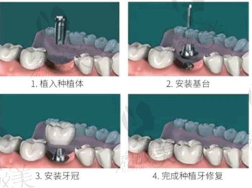 北京圣诺口腔数字化种植牙流程