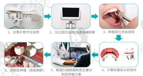 北京圣诺口腔数字化种植牙流程