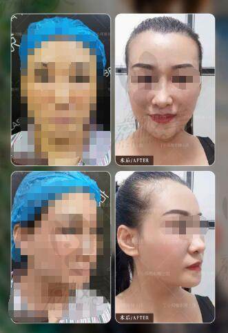 北京艾玛医疗美容诊所脸部取奥美定后图片