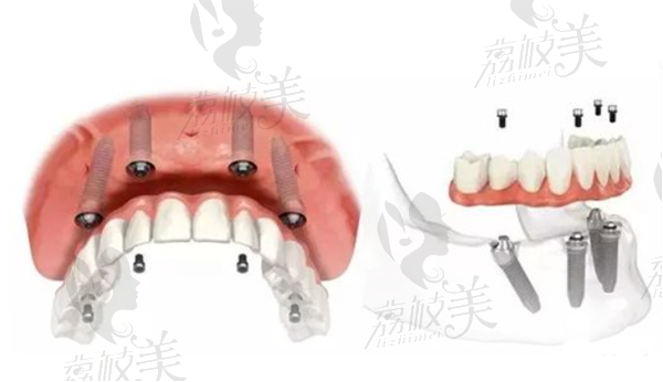 “all-on-4”的种植牙技术