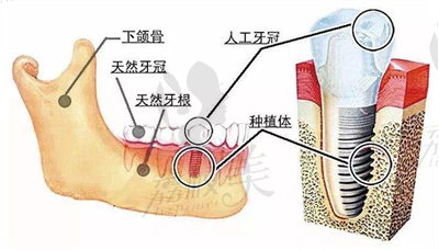 刘跃医生做的种植牙手术的技术优势.jpg